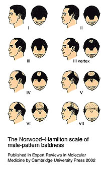 Norwood scale of hair thinning and balding
